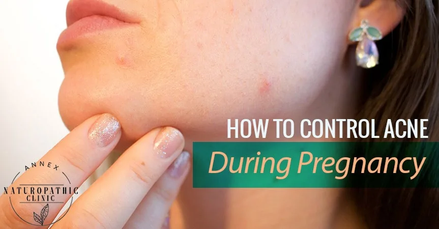 How To Control Acne During Pregnancy | Annex Naturopathic Clinic | Toronto Naturopathic Doctors