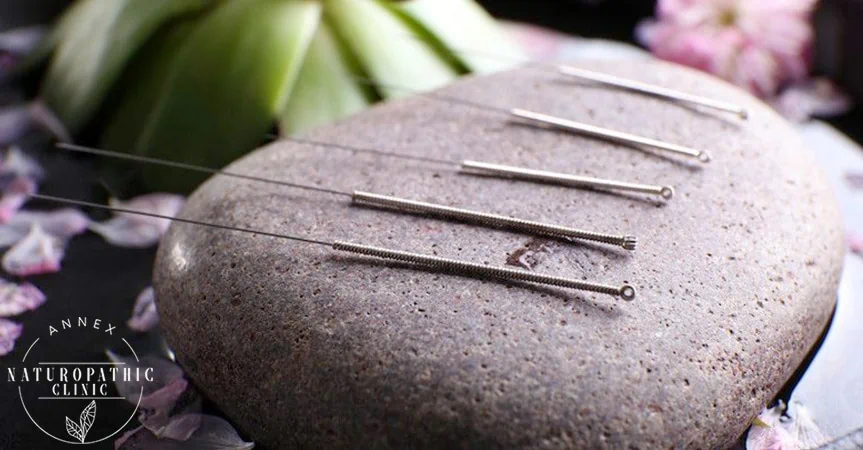 Acupuncture and the benefits of it | Annex Naturopathic Clinic | Toronto Naturopathic Doctors