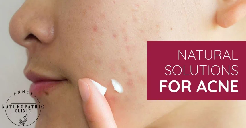 Natural Solutions For Acne | Annex Naturopathic Clinic | Toronto Naturopathic Doctors