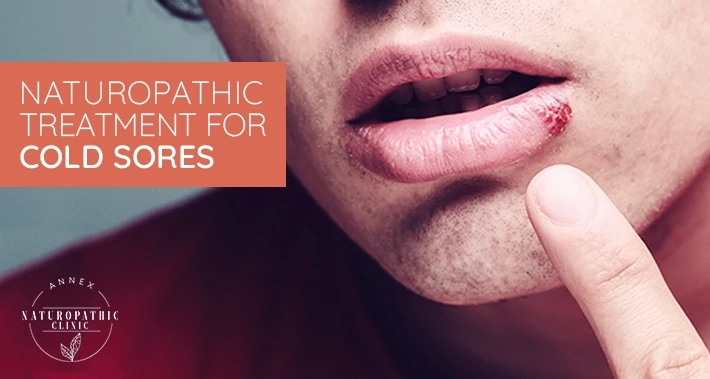 Naturopathic Treatment For Cold Sores | Annex Naturopathic Clinic | Toronto Naturopathic Doctors