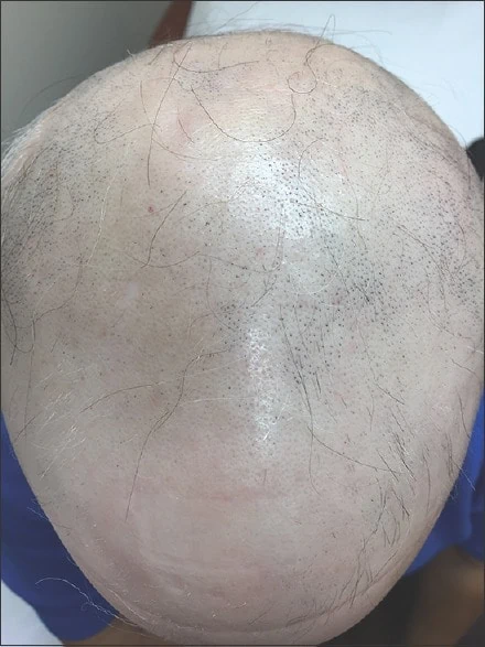 alopecia totalis - complete hair loss