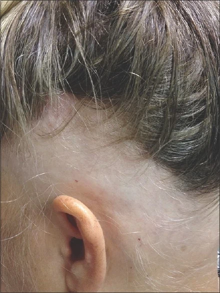 alopecia around the ears