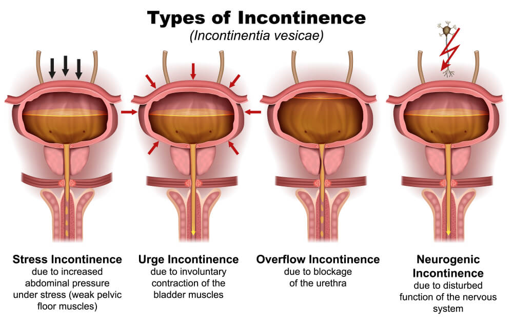 different types and symptoms of urinary incontinence