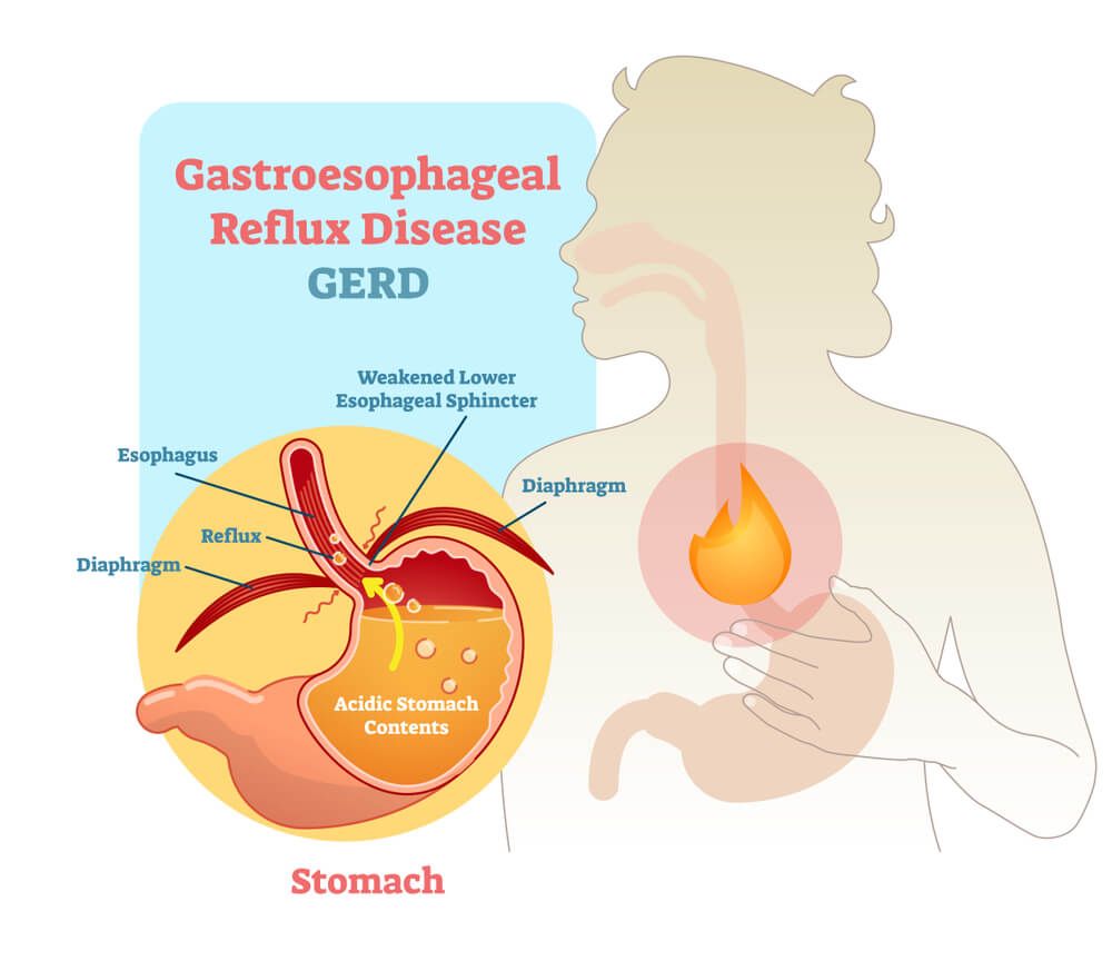 what is acid reflux and Gastroesophageal Reflux Disease  