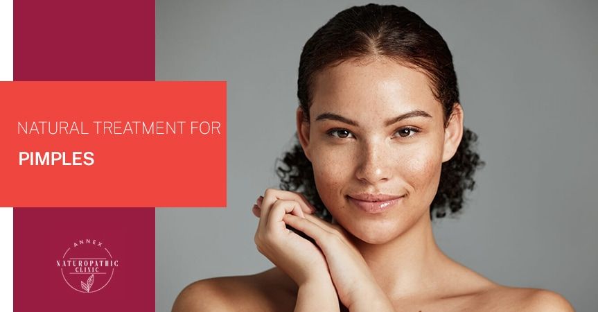 natural treatment for pimples