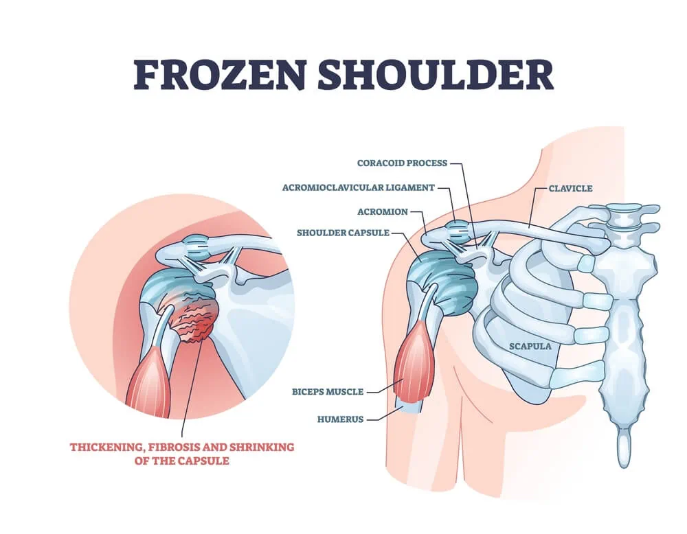 What is Frozen Shoulder