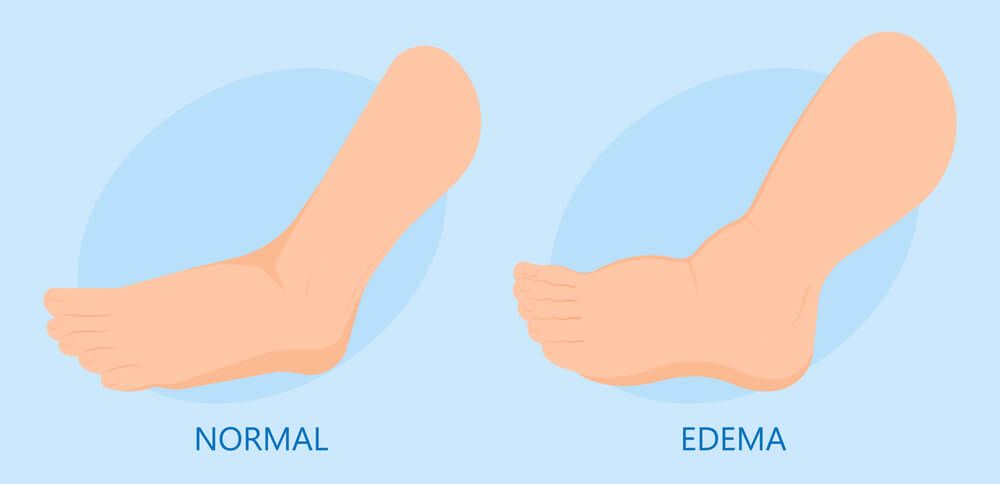 what is edema
