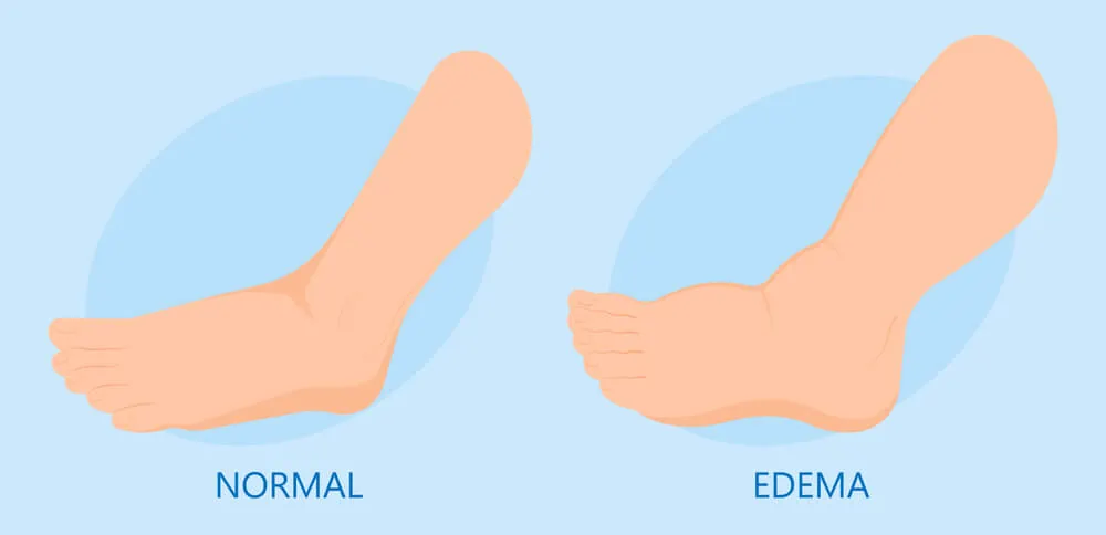 Swelling (oedema) remedies: photos