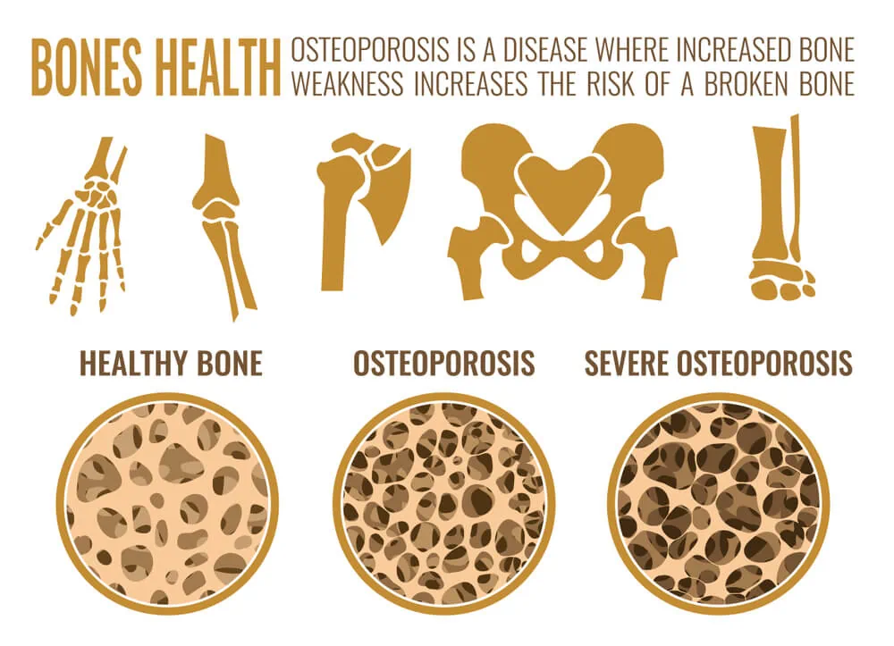 what is osteoporosis